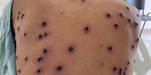 Minas registra novos casos de mpox e total chega a 17