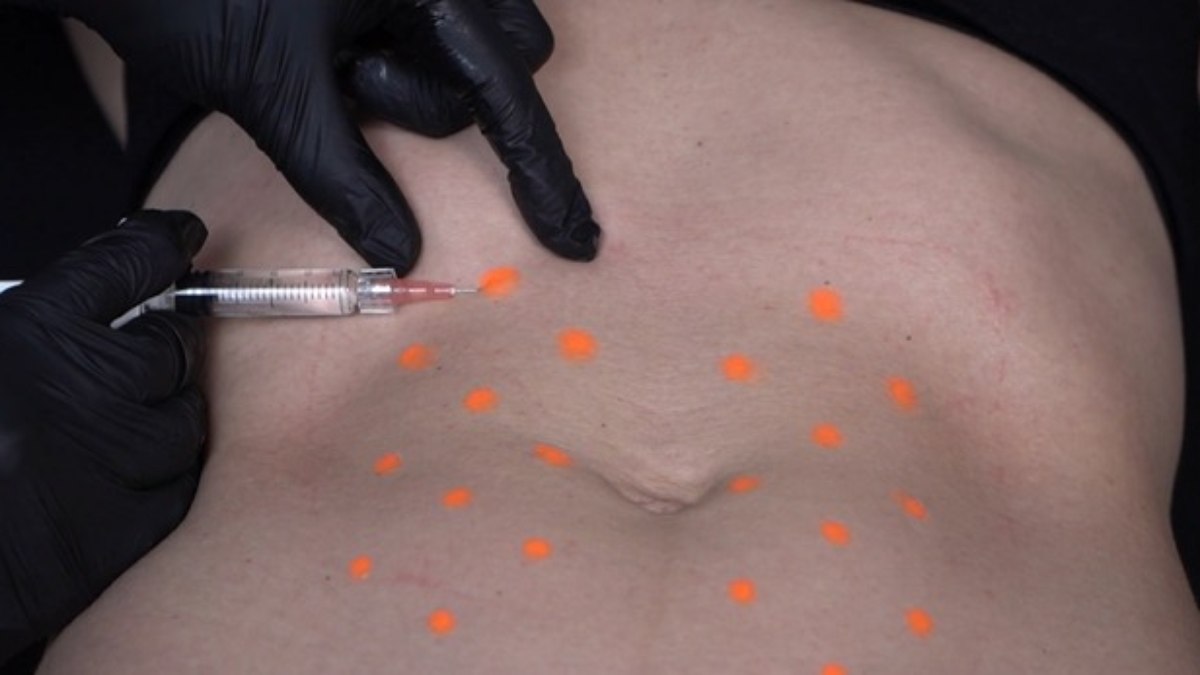 Nova técnica pode ser aplicadas em várias partes do corpo, inclusive o abdômen