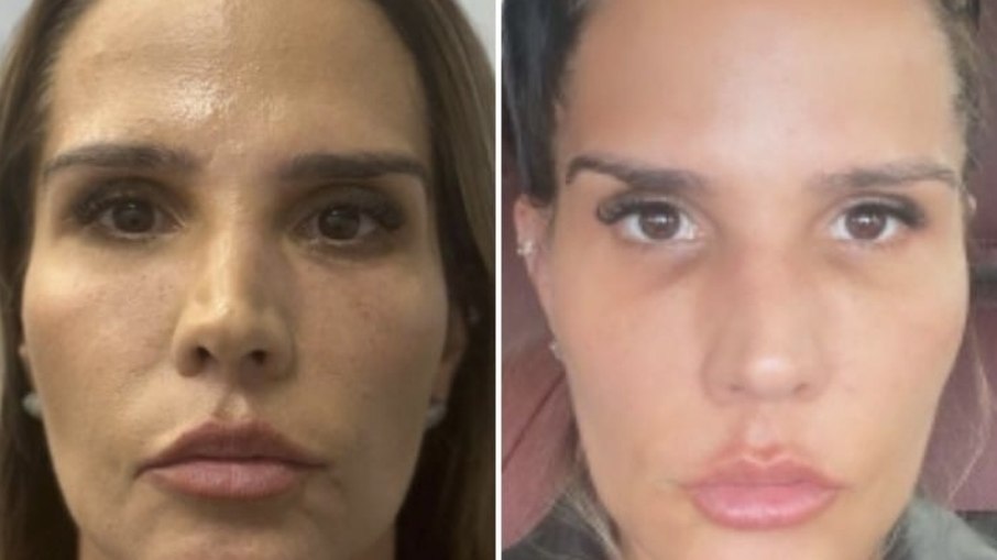 Confira o antes e o depois de Taty Zatto após harmonização facial