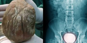Pedra gigante de 1,3kg é retirada da bexiga de homem