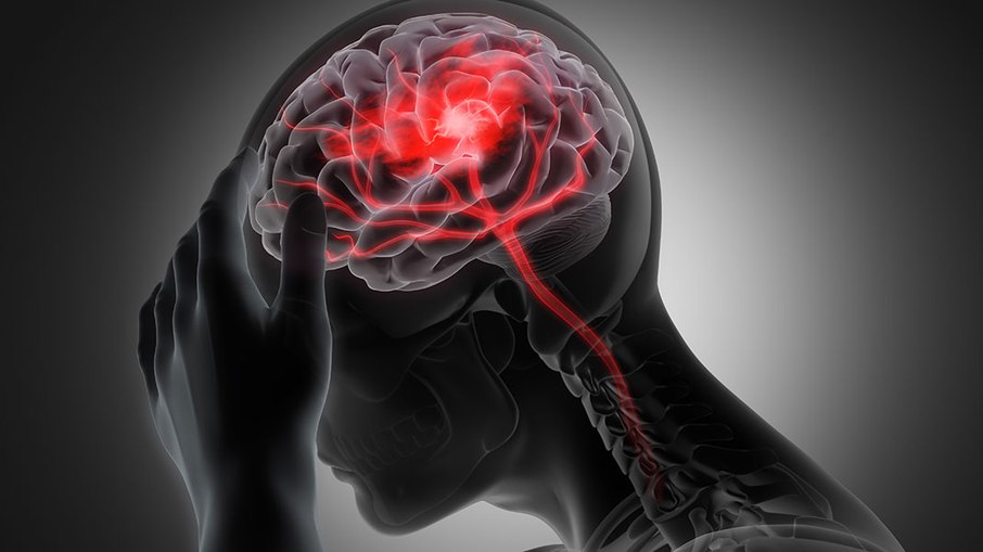 O AVC é a interrupção do fluxo sanguíneo no cérebro, causada por obstrução ou rompimento de vasos, que pode gerar sequelas graves ou até levar à morte