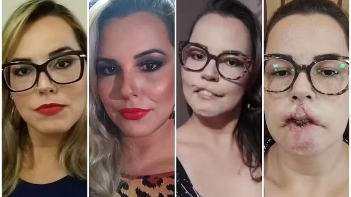 Influenciadora perde lábio em procedimento e alerta: 'Fui enganada' Influenciadora perde lábio em procedimento e alerta: 'Fui enganada'