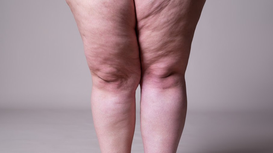 Dermolipectomia deixa as pernas mais simétricas