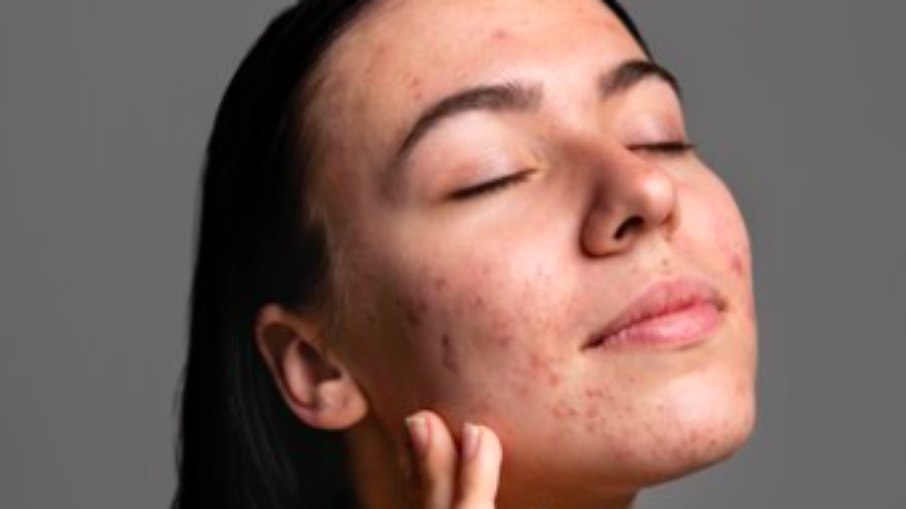 Seis dicas de skincare para pele acneica