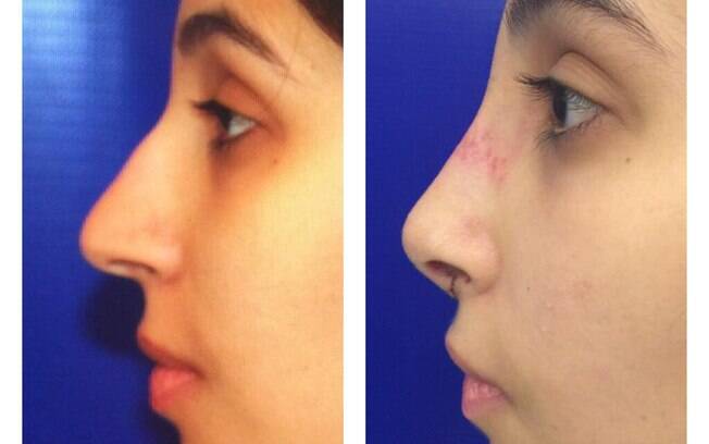Antes e depois de uma rinoplastia Antes e depois de uma rinoplastia