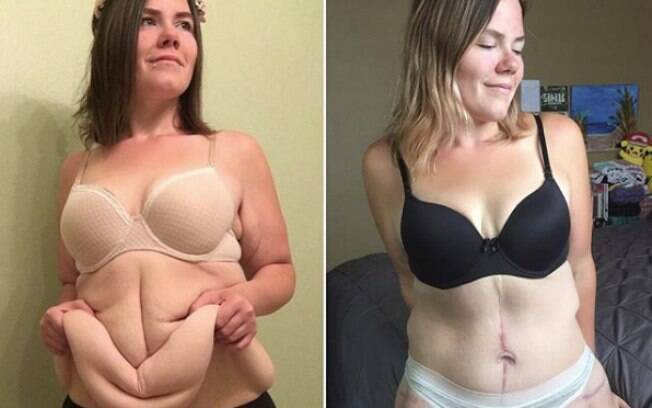 Influenciadora digital Amanda Roberts ganhou cirurgia para remoção do excesso de pele durante programa de televisão