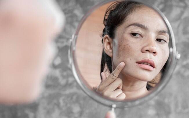 Receitas caseiras para tratamento de Melasma podem agravar as manchas