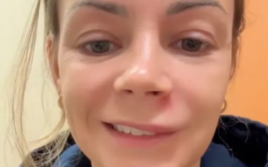 Mulher é internada após espremer espinha no rosto