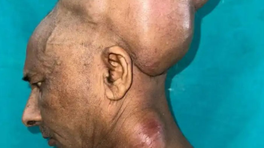 Homem retirou tumor de 6 kg da cabeça