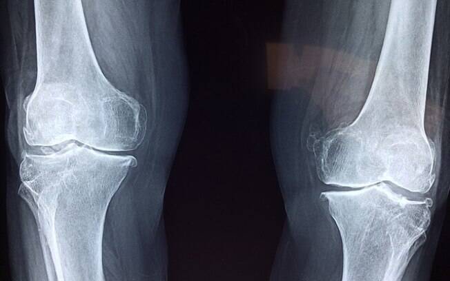 Os médicos ficaram surpresos ao encontrarem as agulhas nas pernas da mulher(foto meramente ilustrativa)