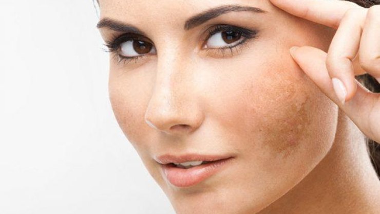 Melasma no verão: quais cuidados ainda podem ser feitos