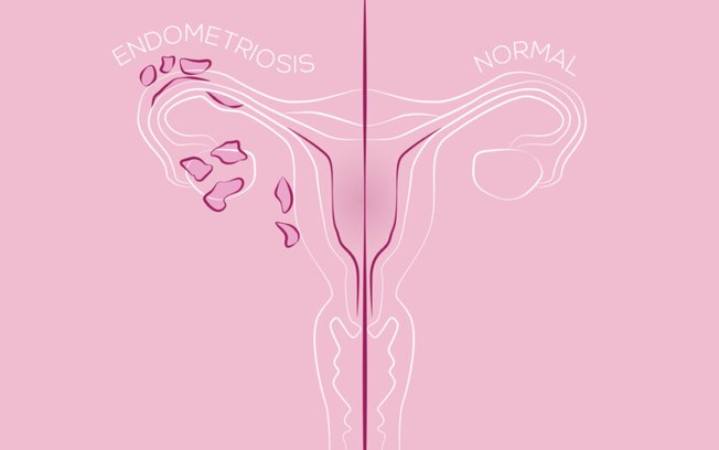 Endometriose: entenda o que é a doença que afeta a cantora Anitta