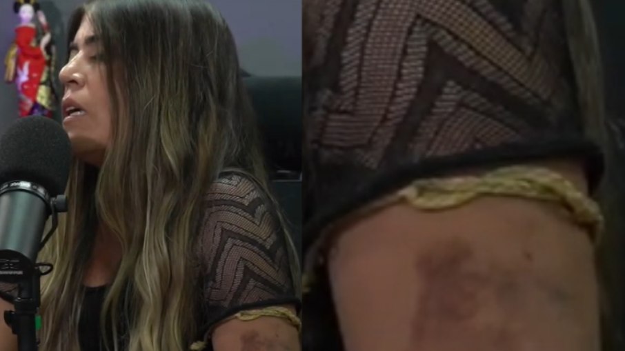 Bruna Surfistinha conta que foi agredida por ex e mostra hematoma