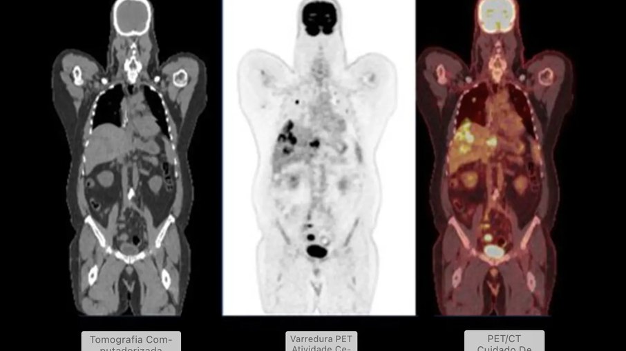Os médicos usam PET-CT para diagnosticar câncer e doenças inflamatórias, além de monitorar os efeitos do tratamento