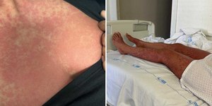 Mulher tem alergia grave após ser medicada com amoxicilina