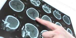 Casos de infarto e AVC aumentam no frio; especialista explica motivos