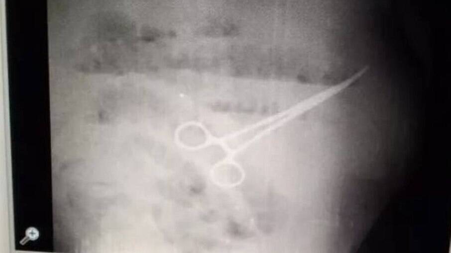 Paciente teve tesoura esquecida no corpo após cirurgia na Venezuela
