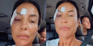 Ivete Sangalo recebe alta e deixa hospital com olho roxo
