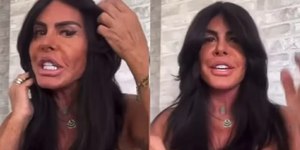 Gretchen mostra nova harmonização facial e exibe rosto sem filtro