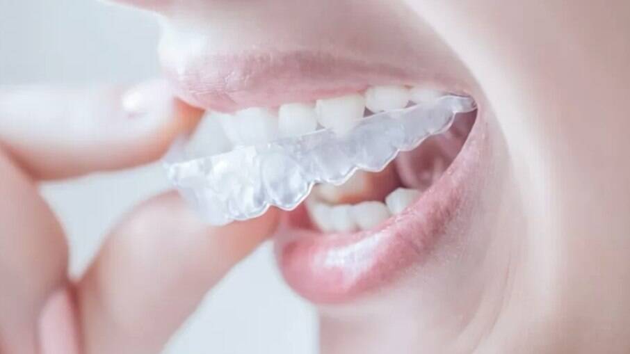Alinhador dental