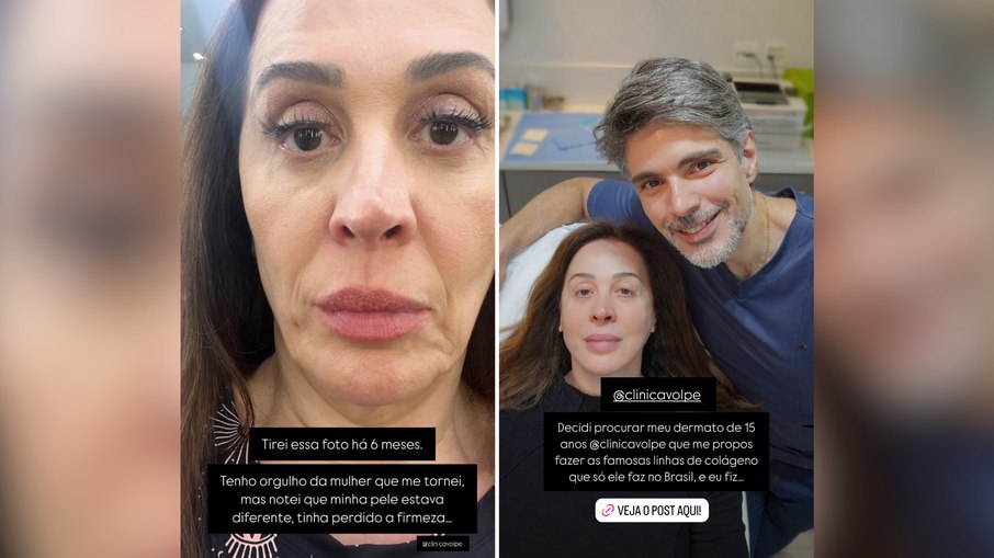 Claudia Raia exibe transformação após procedimento estético Claudia Raia exibe transformação após procedimento estético