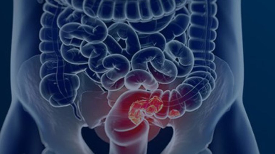 Câncer colorretal Câncer colorretal