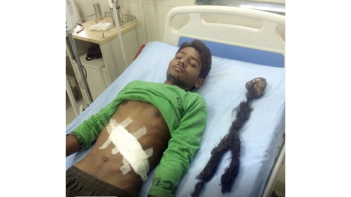 Jovem descobre que carregava o próprio gêmeo dentro do corpo