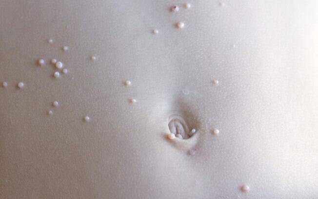 Molusco contagioso forma pequenas pápulas umbilicadas e brilhosas na pele; ao coçar, pode atingir outras regiões do corpo
