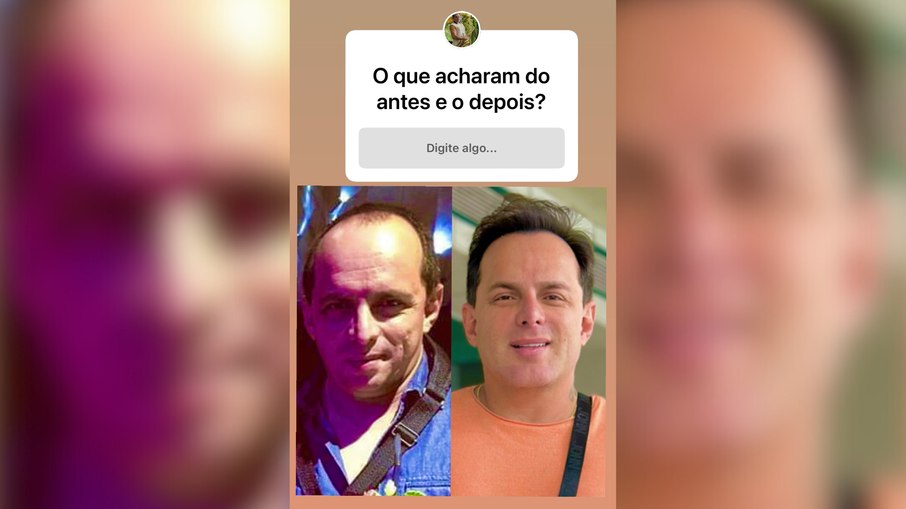 Marido de Gretchen impressiona com antes e depois de transformação facial