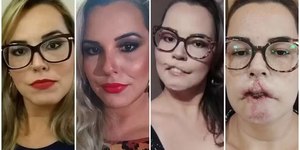 Influenciadora perde lábio em procedimento: "Fui enganada"