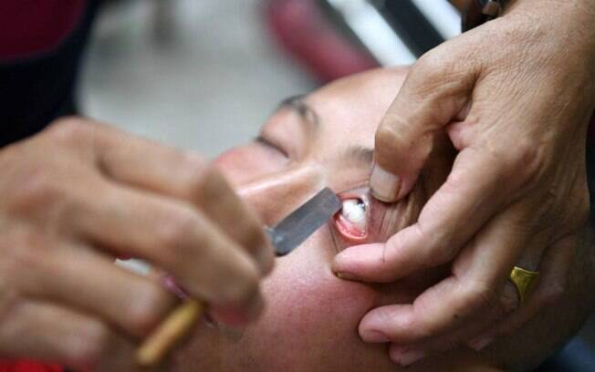 Na China, uma prática um tanto quanto diferente depila os olhos com faca para melhorar a visão da pessoa