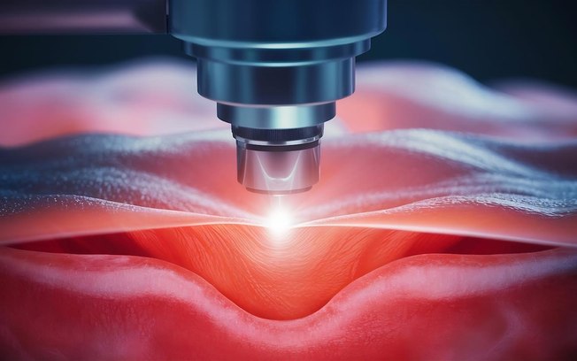 Laser traz mais precisão para cirurgias proctológicas