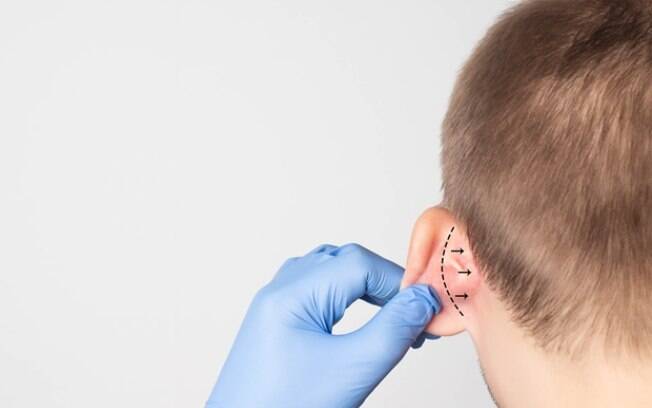 Técnica inovadora permite correção de orelhas abertas sem cirurgia