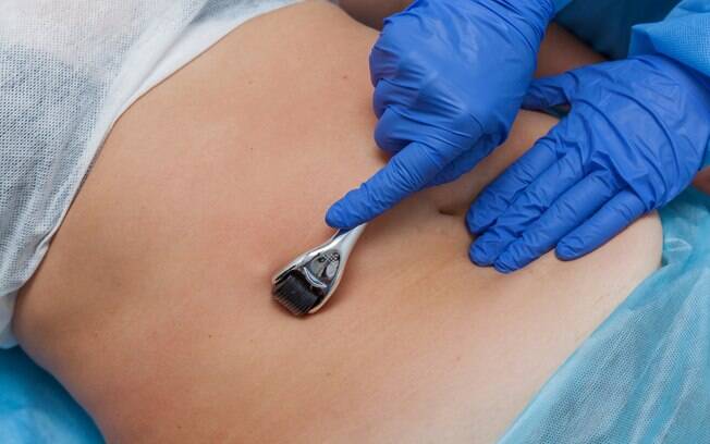 A carboxiterapia é um procedimento que injeta gás carbônico na pele. Ele pode custar de R$ 160 a R$ 600