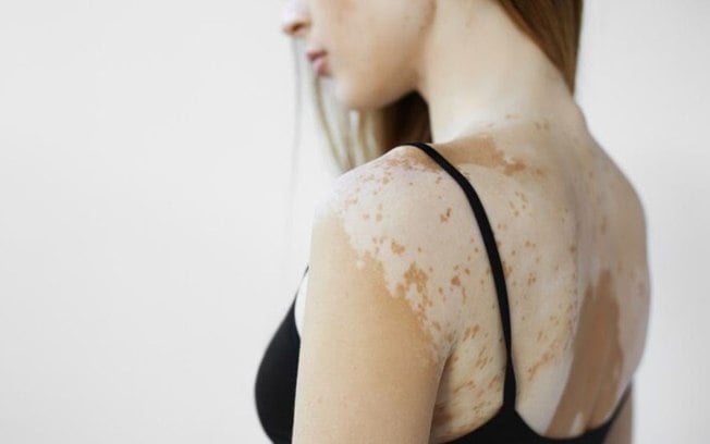 Vitiligo: confira dicas de cuidados especiais com a pele