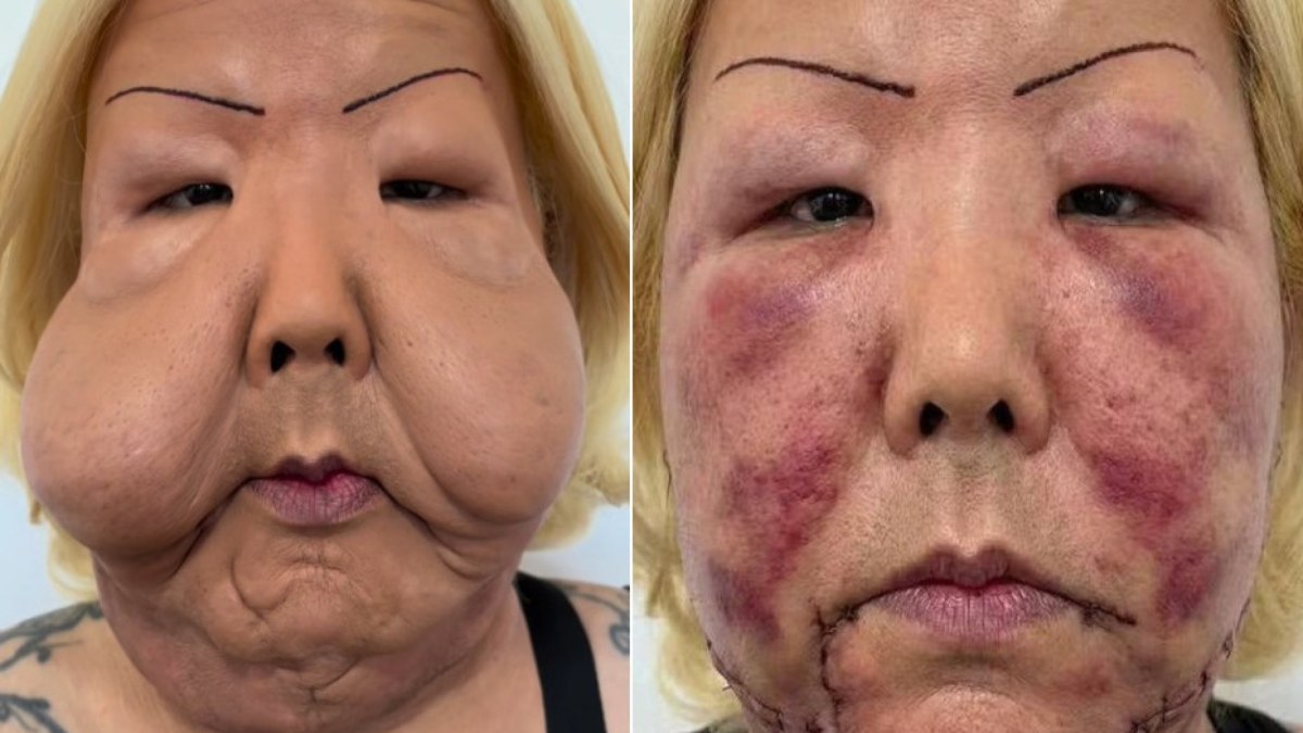 Revelan el impacto del aceite mineral en la cirugía: un hallazgo sorprendente