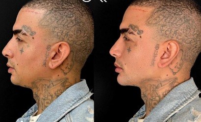 MC Guimê surpreende ao mostra antes e depois de harmonização