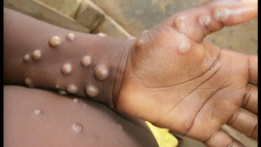 Varíola dos macacos: 15 países registraram casos da doença | Saúde | iG