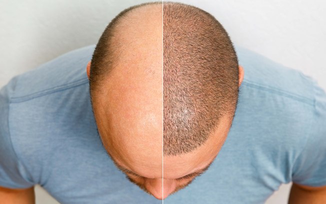 Personalização maximiza efeitos do transplante capilar