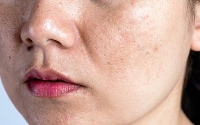 Criomodulação Glacial é a novidade para remoção de manchas e melasma
