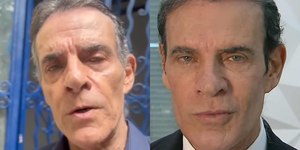 Mário Gomes passa por harmonização facial