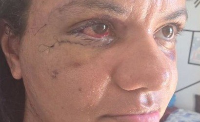 Mulher espancada com 61 socos mostra o rosto após cirurgias