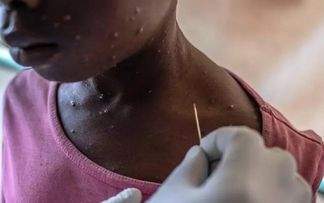 Vacina brasileira contra a mpox está próxima dos testes em humanos