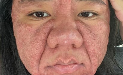 Acne gravídica: como a gravidez afeta a pele da gestante