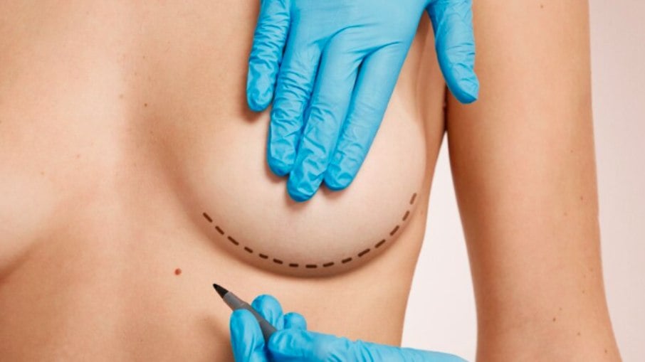 Mastopexia e mamoplastia sem prótese: estamos vivendo uma mudança de tendência?