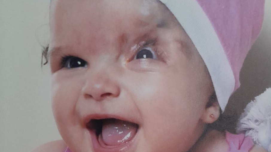 Beatriz nasceu com malformação craniofacial e sem a pálpebra esquerda Beatriz nasceu com malformação craniofacial e sem a pálpebra esquerda