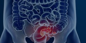 Câmara aprova projeto que inclui prevenção do câncer colorretal