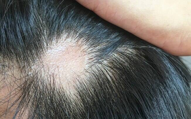 Efeitos da Covid-19: o que causa e como tratar a queda de cabelo que afeta 1 em 4 infectados