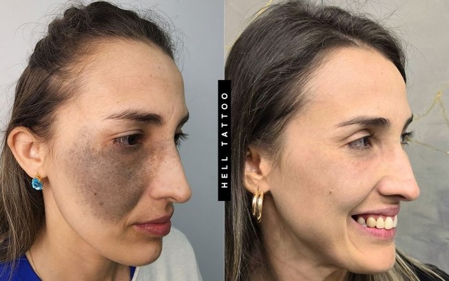 Nevo de Ota pode ser tratado com laser, explica biomédico Nevo de Ota pode ser tratado com laser, explica biomédico