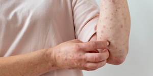 Minas registra novos casos de mpox e total chega a 17